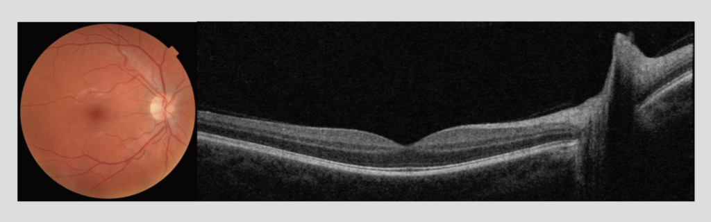 Figure 1: Maestro2 color fundus photograph and wide-field OCT images captured in a single scan 