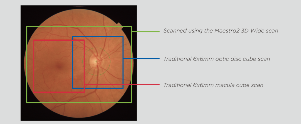 Figure 2: Green boxed region represents area scanned using the Maestro 3D Wide scan. Blue boxed area represents area scanned using traditional 6x6mm optic disc and macula cube scans.