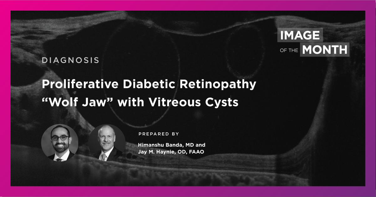 IOTM Proliferative Diabetic Retinopathy “Wolf Jaw” with Vitreous Cysts