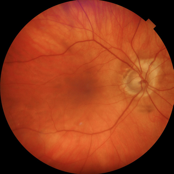 NW500 Non-Mydriatic Retinal Camera