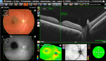 Patient eye results from Maestro2 OCT scan