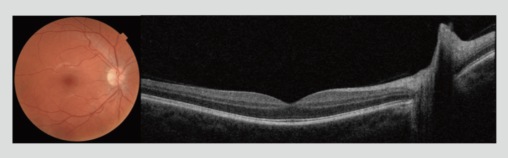 Figure 1: Maestro2 color fundus photograph and wide-field OCT images captured in a single scan