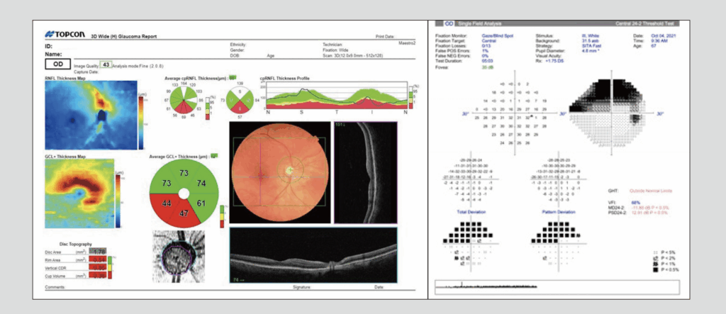 Figure 3: A single wide-field scan capture is able to visualize RNFL loss and retinal ganglion cell loss in the central macula, which is able to be verified with standard automated perimetry