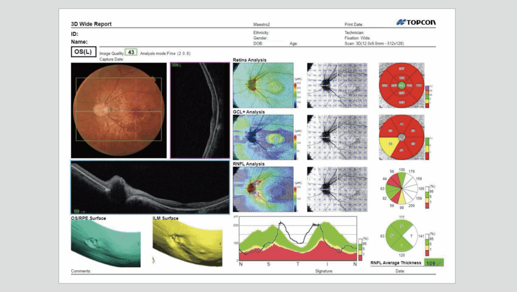 Figure 4: In the Maestro2 OCT report the color fundus photo and the horizontal OCT B-Scan show the extent of retinal pathology as well as optic nerve edema. By only scanning the macula with OCT for patients with macular disease, damage to the optic nerve head and the extent of this damage may be missed or not fully appreciated.