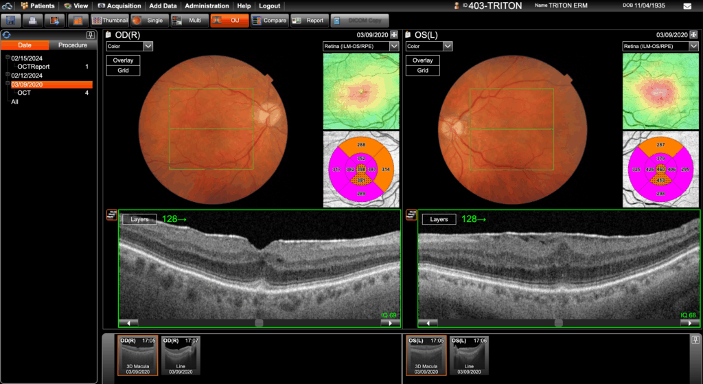 Topcon Triton 3D Macula OU